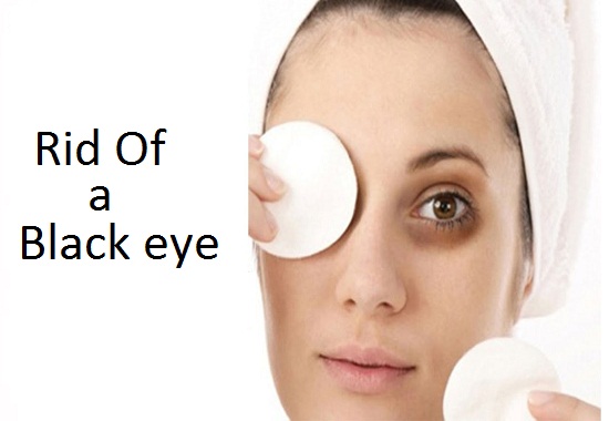 How To Get Rid Of A Black Eye 3426